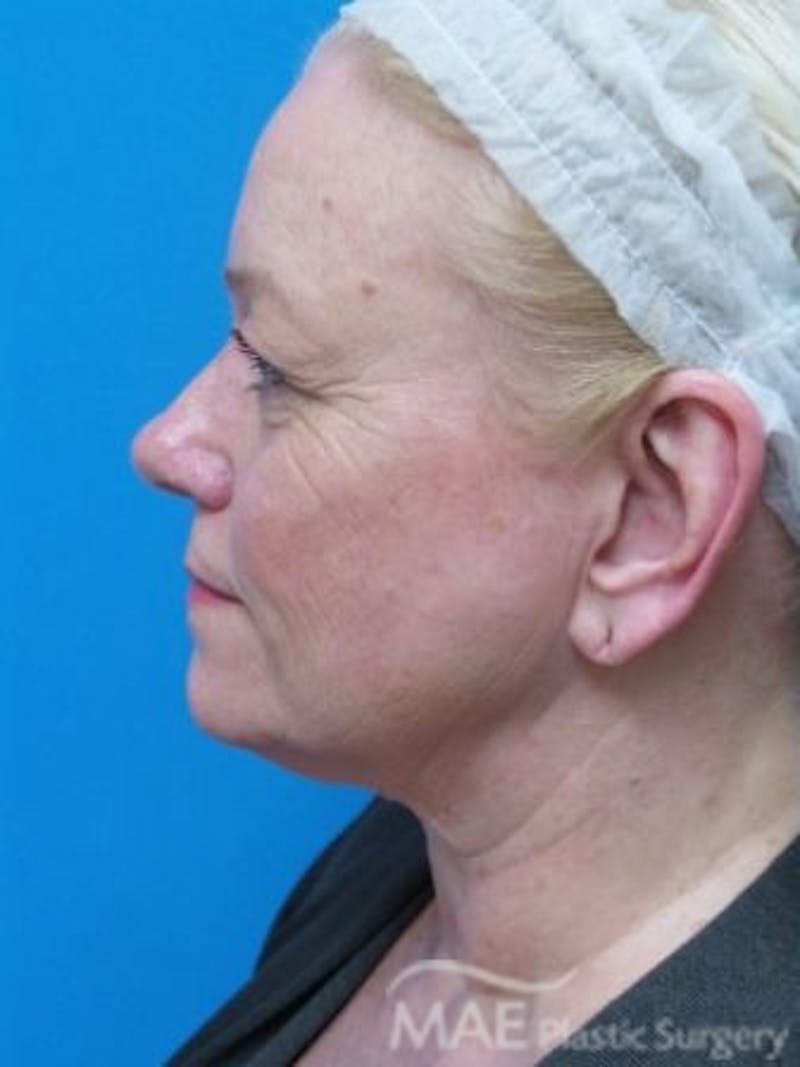 Facelift Before & After Gallery - Patient 170086 - Image 5