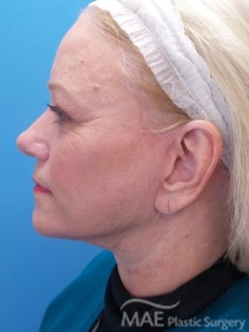 Facelift Before & After Gallery - Patient 170086 - Image 6