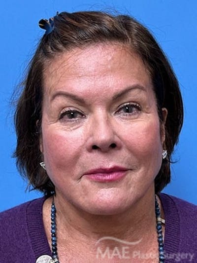 Facelift Before & After Gallery - Patient 172070 - Image 1