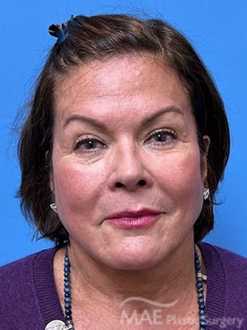 Facelift Before & After Gallery - Patient 172070 - Image 1