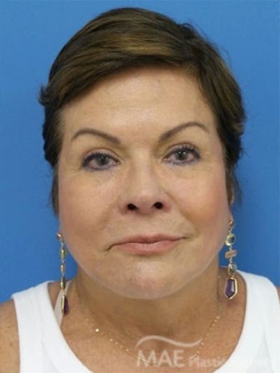 Facelift Before & After Gallery - Patient 172070 - Image 2