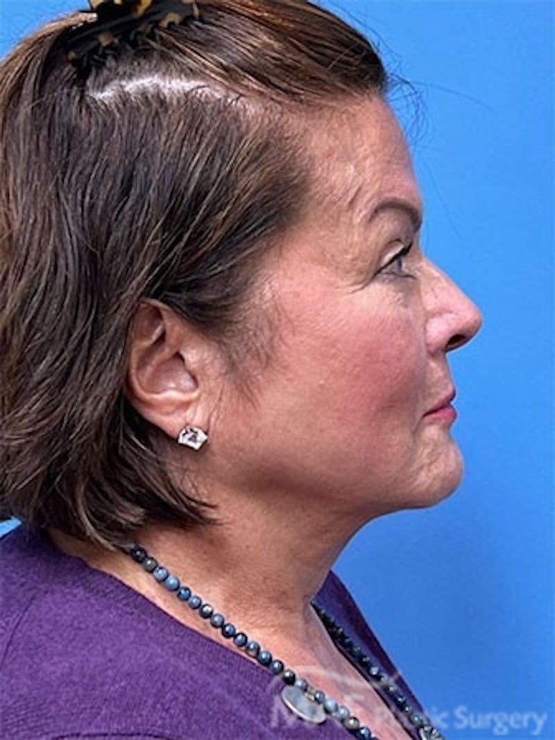 Facelift Before & After Gallery - Patient 172070 - Image 5