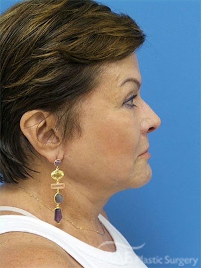 Facelift Before & After Gallery - Patient 172070 - Image 6