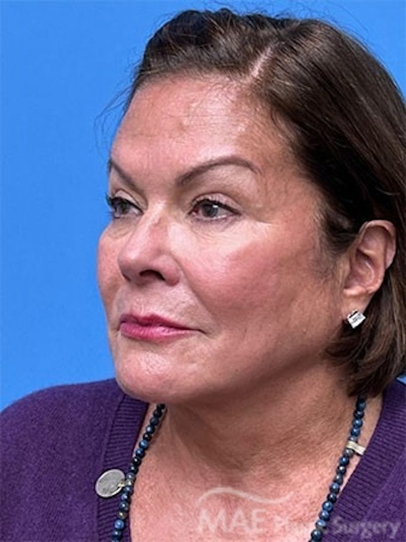 Facelift Before & After Gallery - Patient 172070 - Image 3