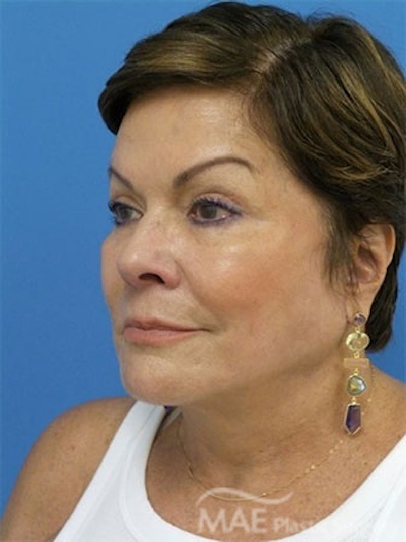 Facelift Before & After Gallery - Patient 172070 - Image 4