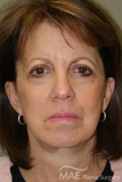 Facelift Before & After Gallery - Patient 319874 - Image 1