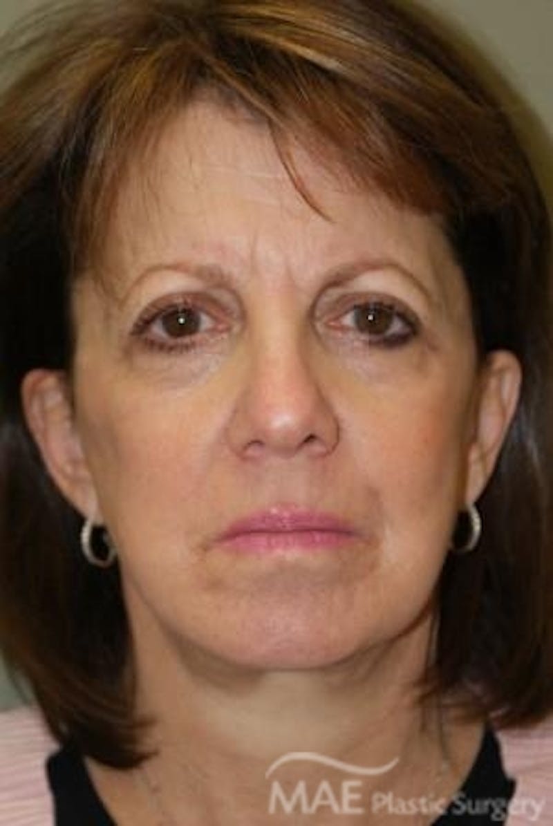 Facelift Before & After Gallery - Patient 319874 - Image 1