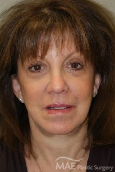 Facelift Before & After Gallery - Patient 319874 - Image 2