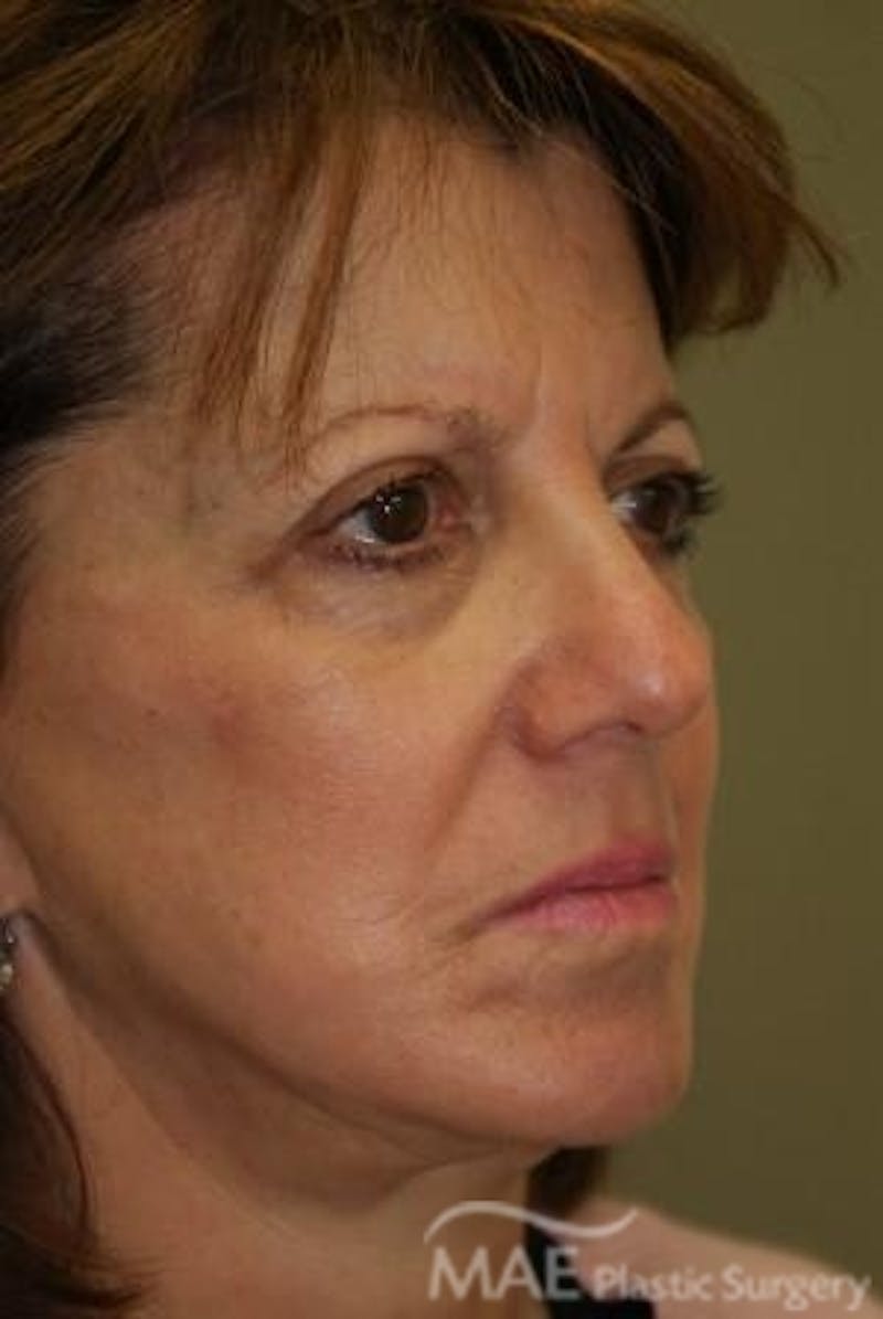 Facelift Before & After Gallery - Patient 319874 - Image 3