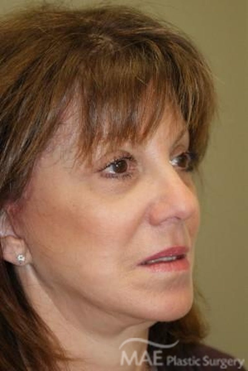 Facelift Before & After Gallery - Patient 319874 - Image 4