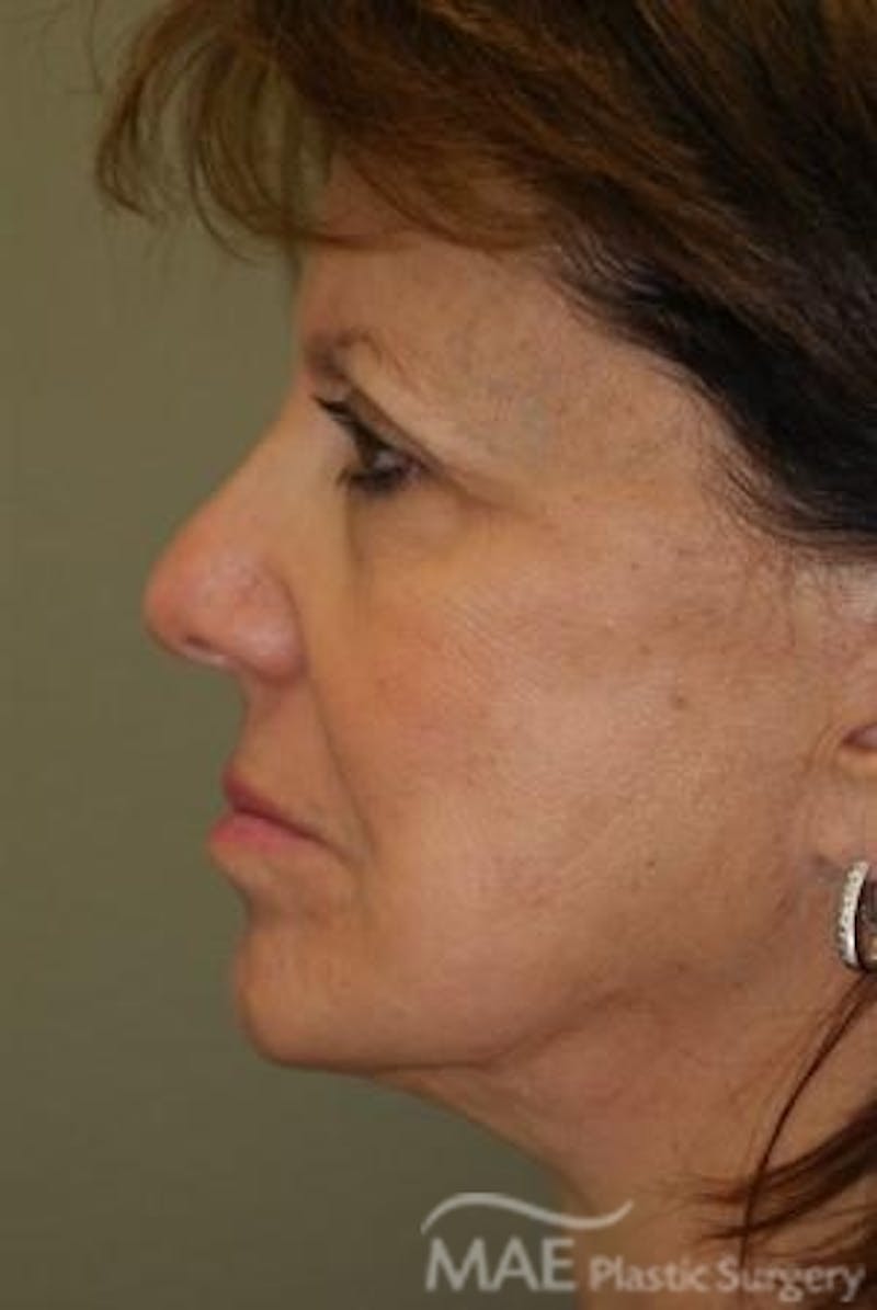 Facelift Before & After Gallery - Patient 319874 - Image 5