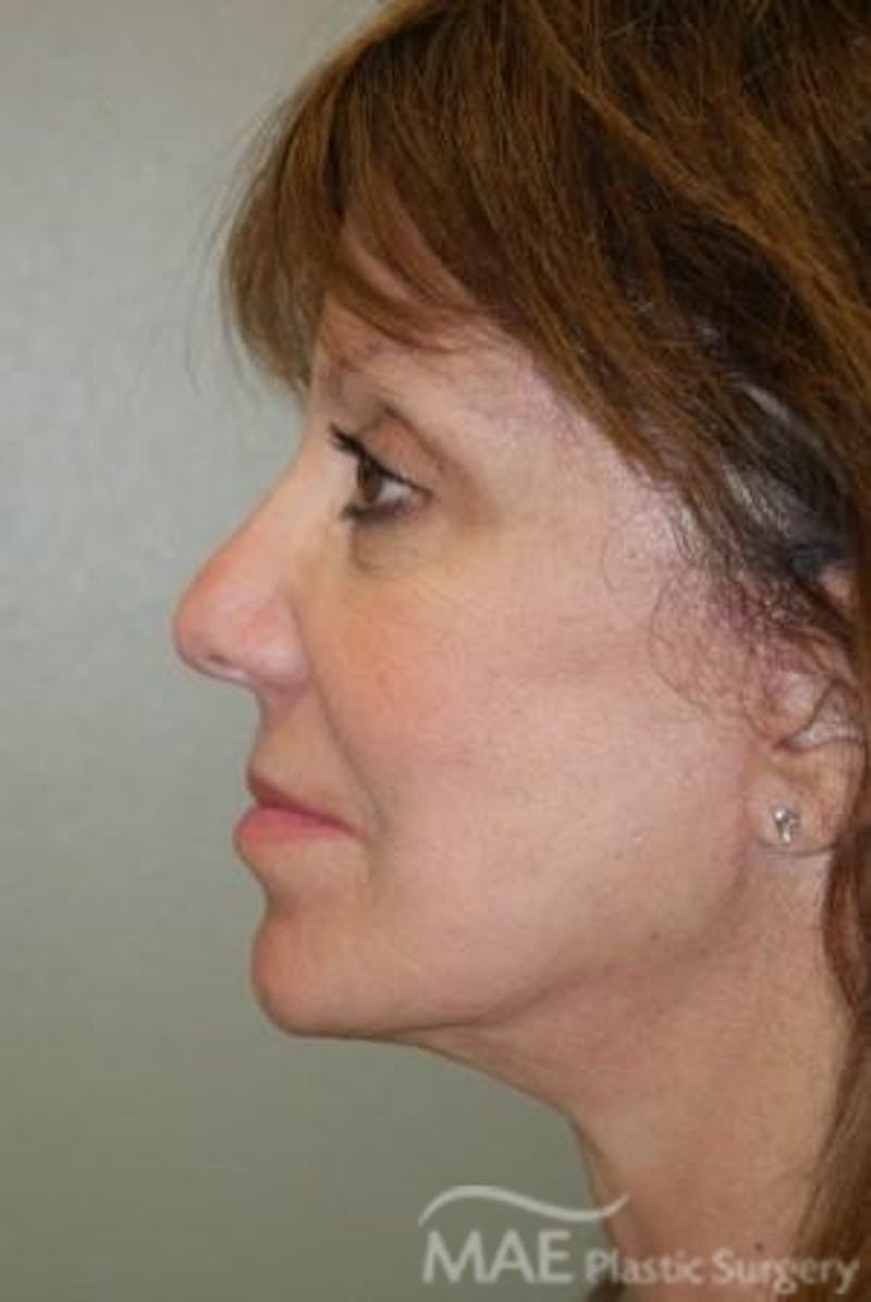 Facelift Before & After Gallery - Patient 319874 - Image 6
