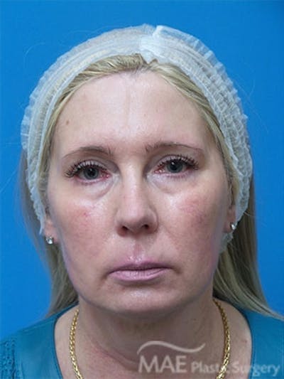 Facelift Before & After Gallery - Patient 429015 - Image 1