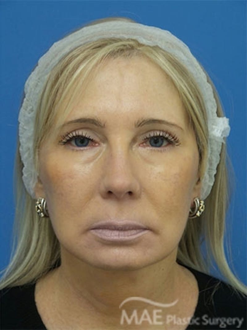 Facelift Before & After Gallery - Patient 429015 - Image 2