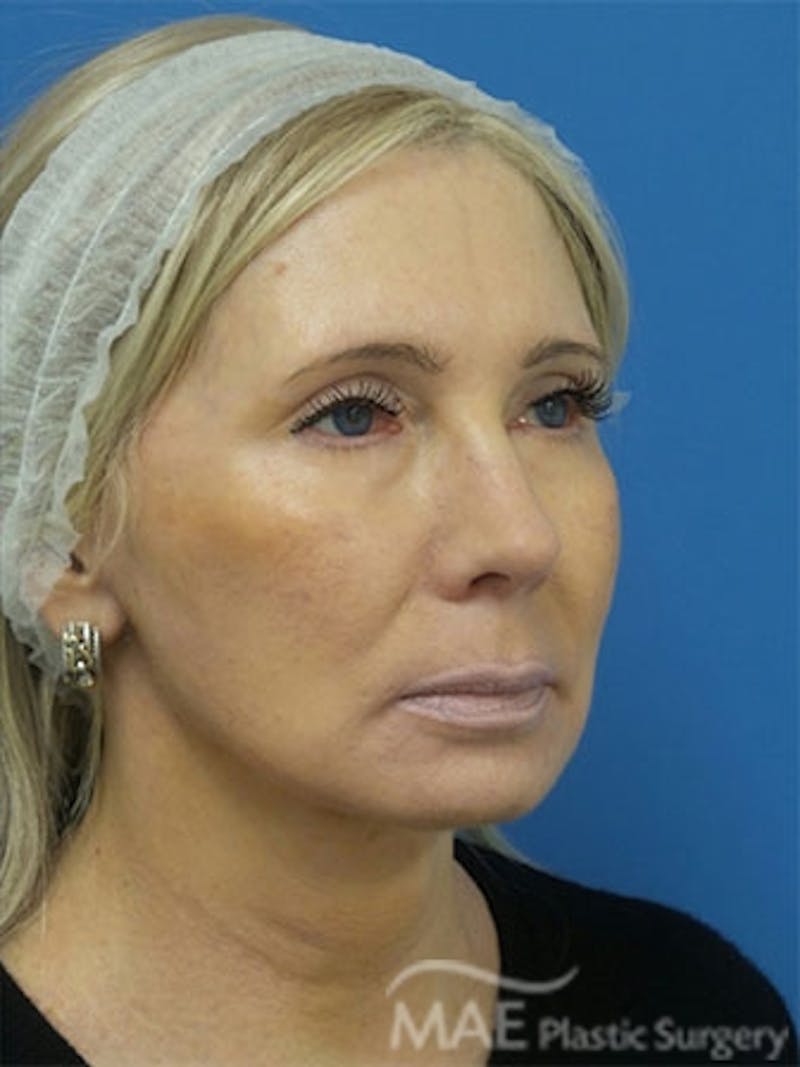 Facelift Before & After Gallery - Patient 429015 - Image 4