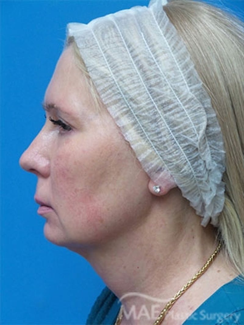Facelift Before & After Gallery - Patient 429015 - Image 5