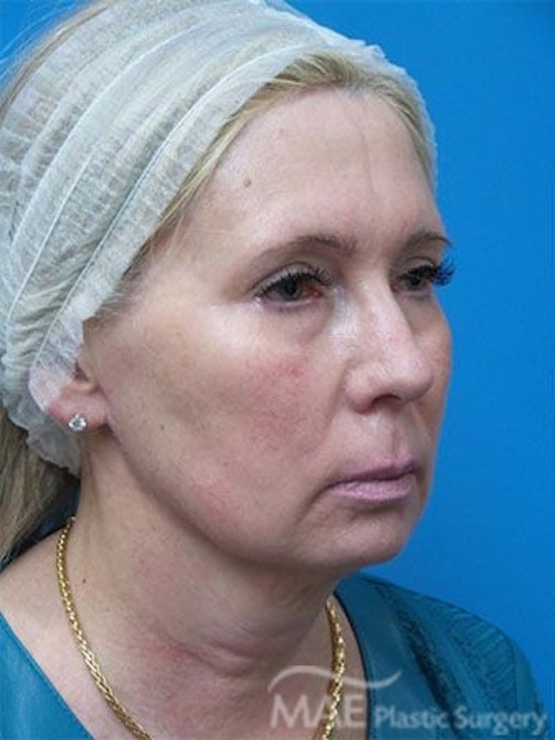 Facelift Before & After Gallery - Patient 429015 - Image 3