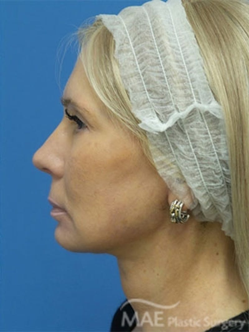Facelift Before & After Gallery - Patient 429015 - Image 6