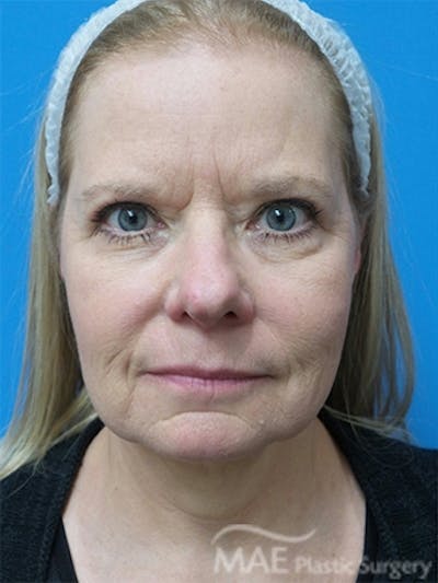 Facelift Before & After Gallery - Patient 778214 - Image 1