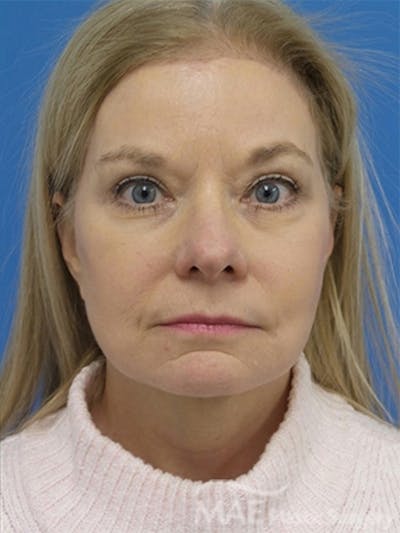 Facelift Before & After Gallery - Patient 778214 - Image 2