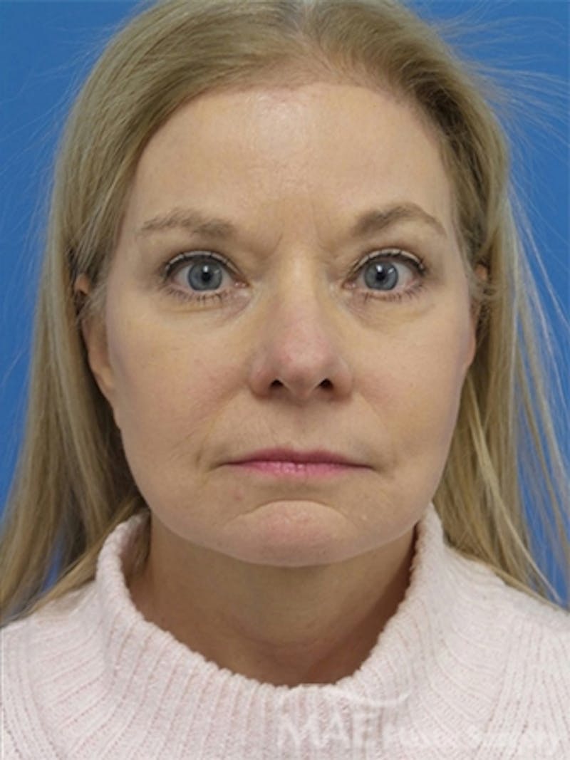 Facelift Before & After Gallery - Patient 778214 - Image 2