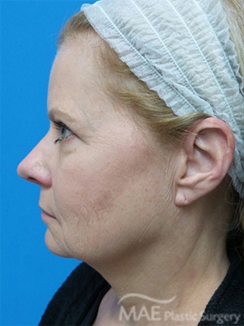 Facelift Before & After Gallery - Patient 778214 - Image 5