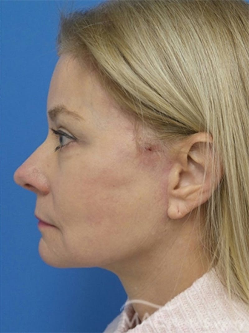 Facelift Before & After Gallery - Patient 778214 - Image 6
