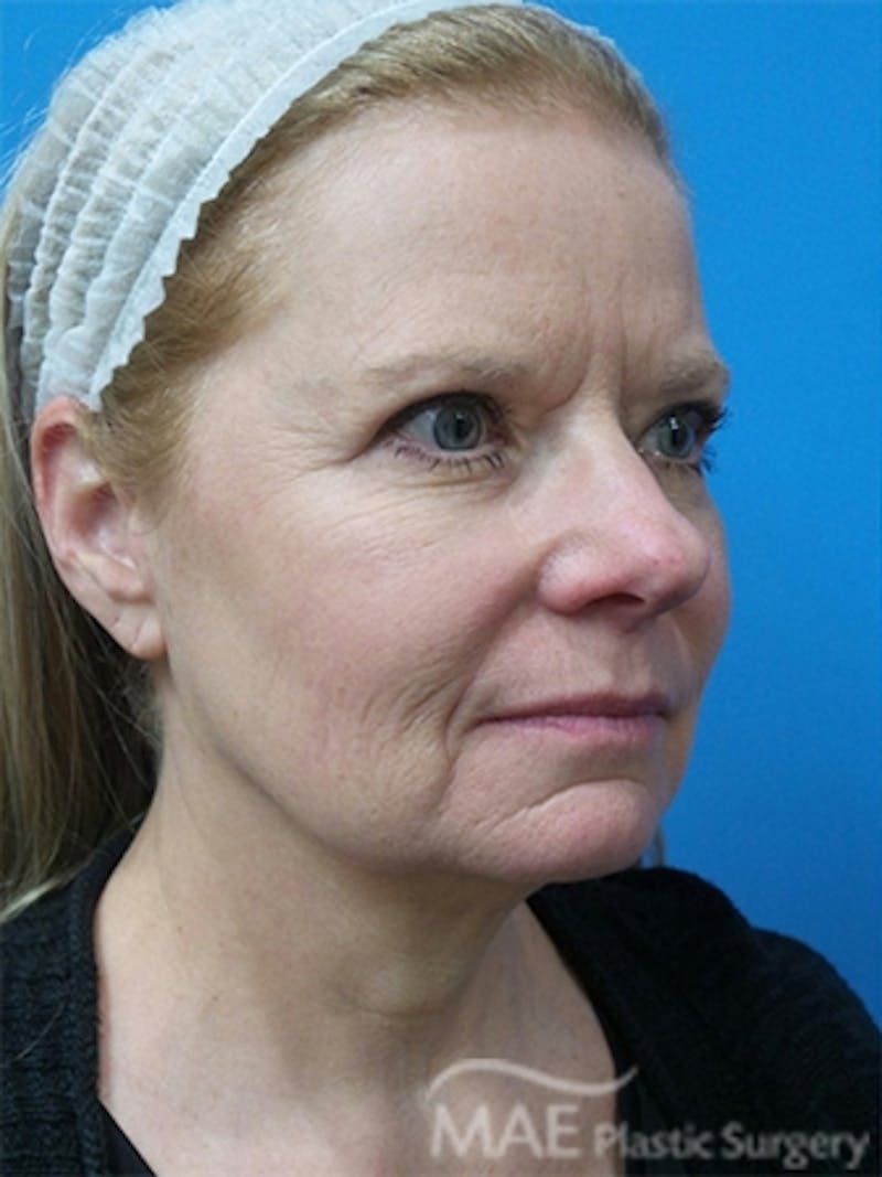 Facelift Before & After Gallery - Patient 778214 - Image 3