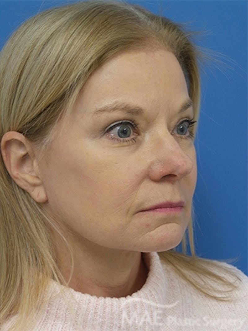 Facelift Before & After Gallery - Patient 778214 - Image 4