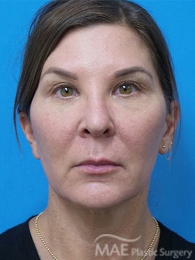 Facelift Before & After Gallery - Patient 601365 - Image 1