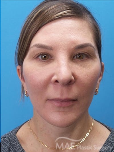 Facelift Before & After Gallery - Patient 601365 - Image 2