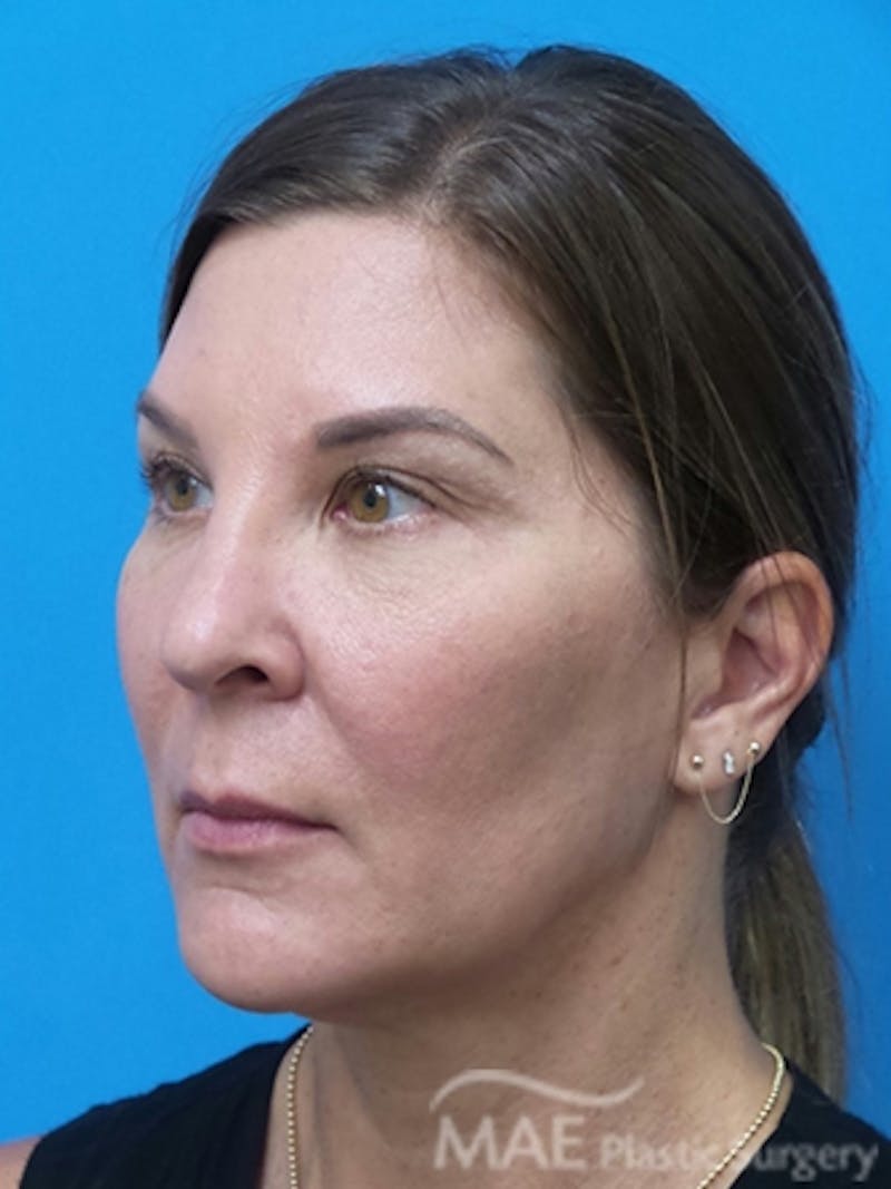 Facelift Before & After Gallery - Patient 601365 - Image 3