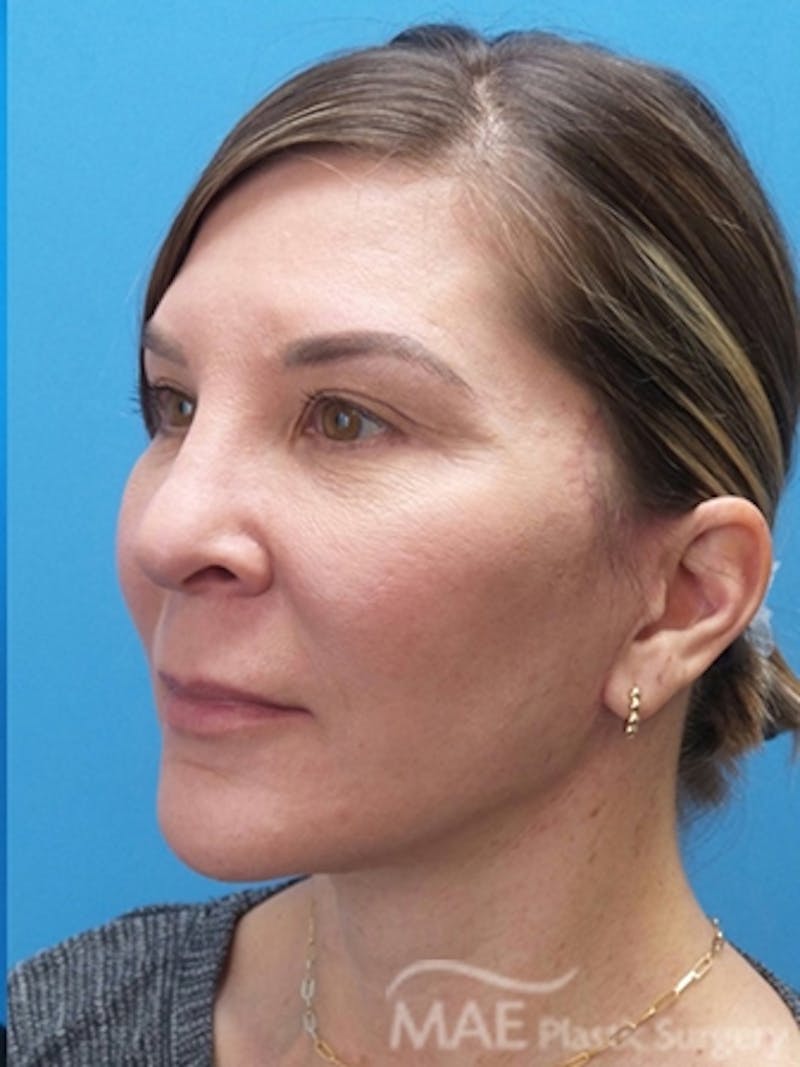 Facelift Before & After Gallery - Patient 601365 - Image 4