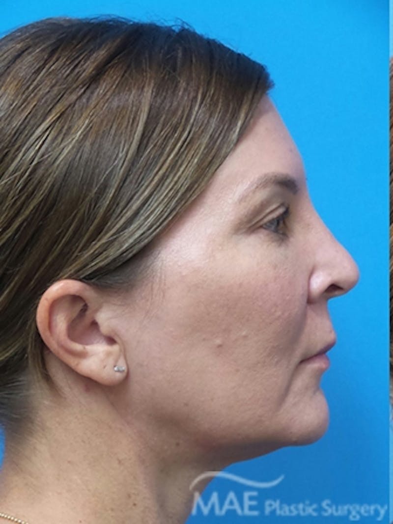 Facelift Before & After Gallery - Patient 601365 - Image 5