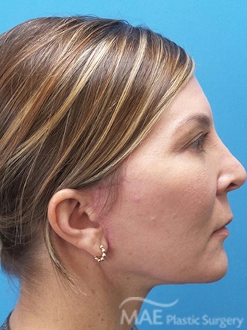 Facelift Before & After Gallery - Patient 601365 - Image 6
