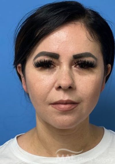 Facelift Before & After Gallery - Patient 414944 - Image 1