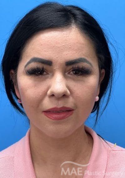 Facelift Before & After Gallery - Patient 414944 - Image 2