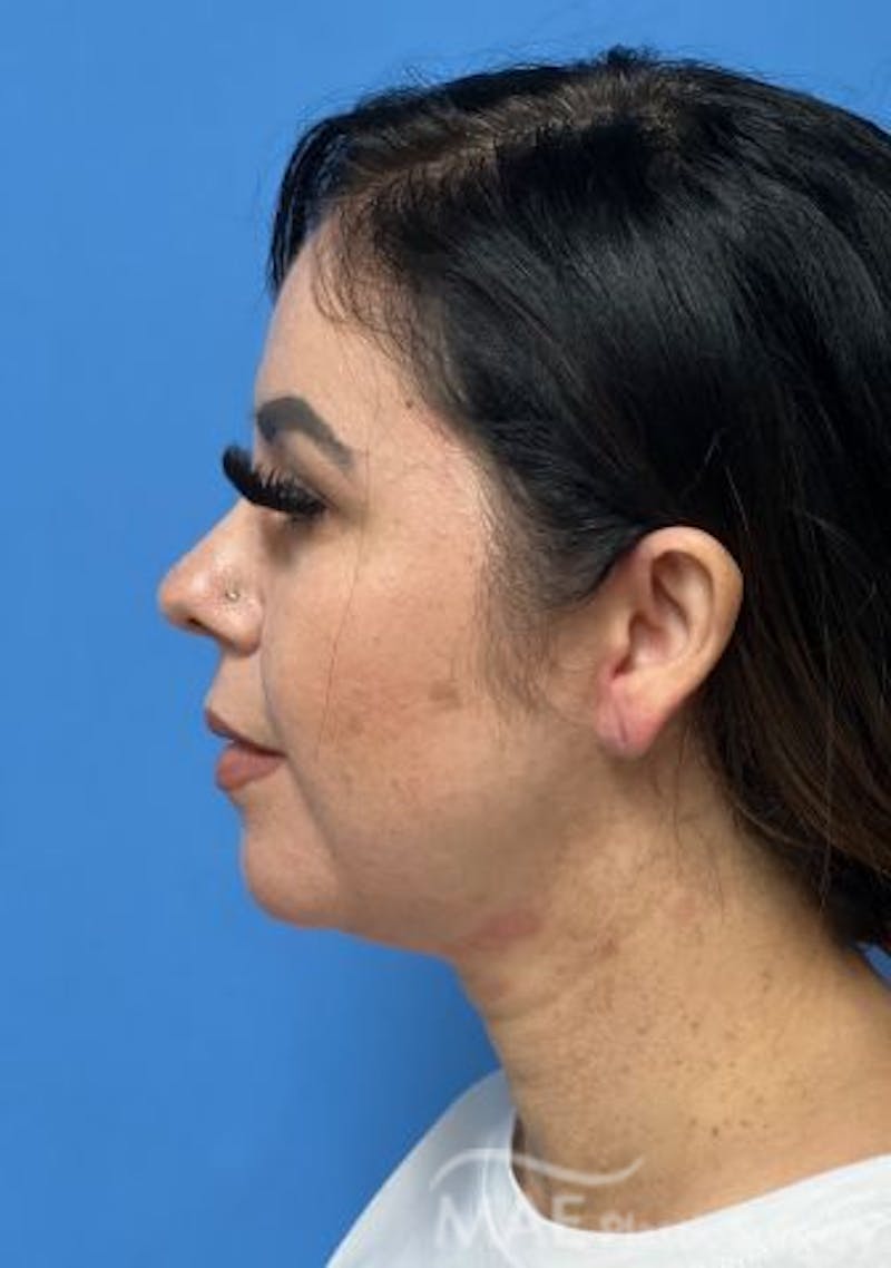 Facelift Before & After Gallery - Patient 414944 - Image 5