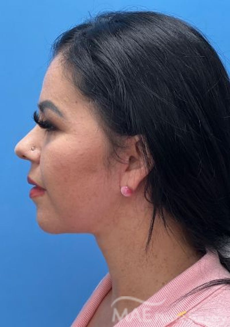 Facelift Before & After Gallery - Patient 414944 - Image 6