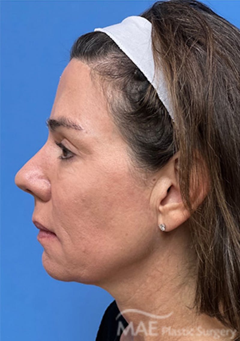 Facelift Before & After Gallery - Patient 375528 - Image 5