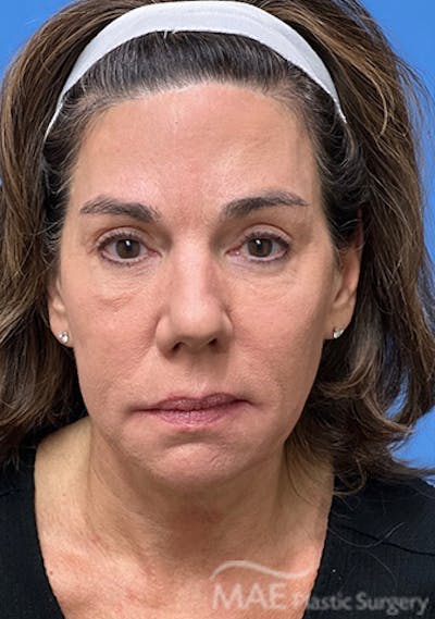Facelift Before & After Gallery - Patient 375528 - Image 1