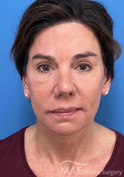 Facelift Before & After Gallery - Patient 375528 - Image 2