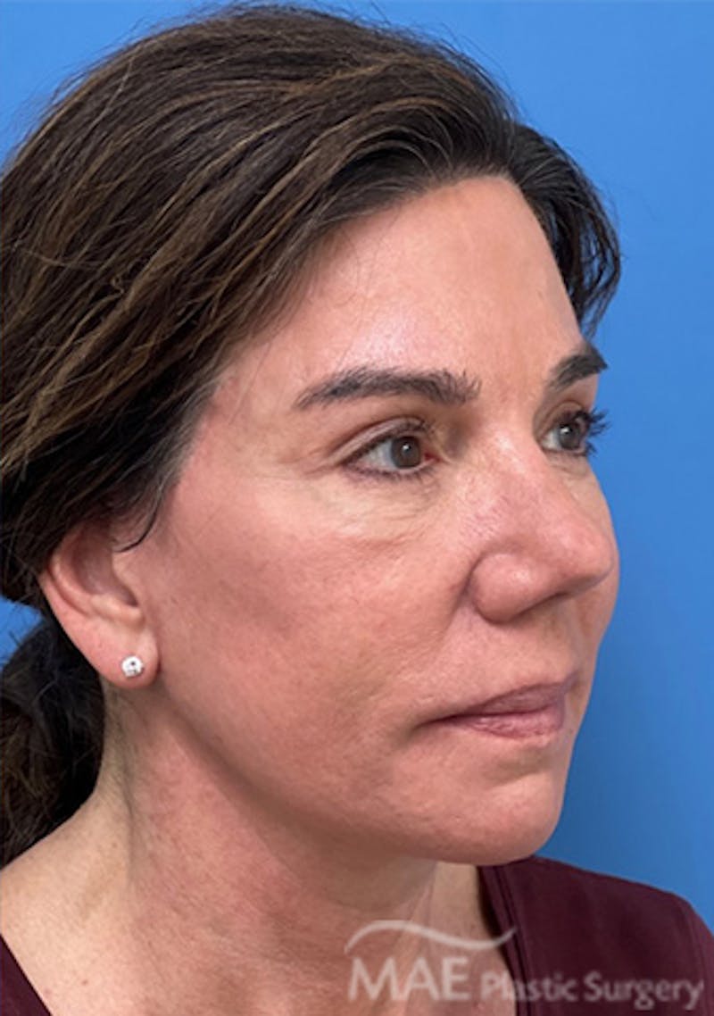 Facelift Before & After Gallery - Patient 375528 - Image 4