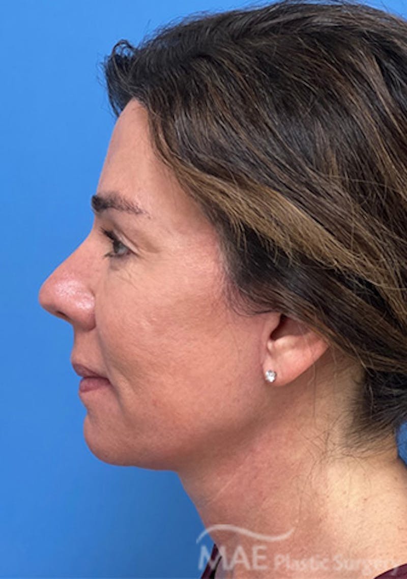 Facelift Before & After Gallery - Patient 375528 - Image 6