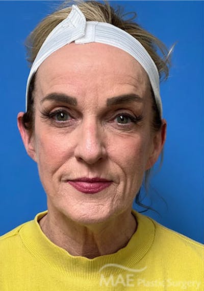 Facelift Before & After Gallery - Patient 394803 - Image 1