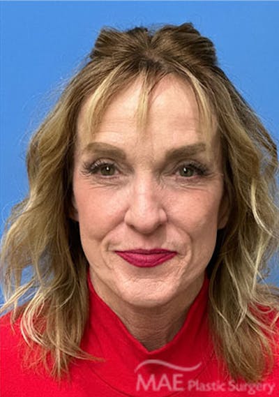 Facelift Before & After Gallery - Patient 394803 - Image 2