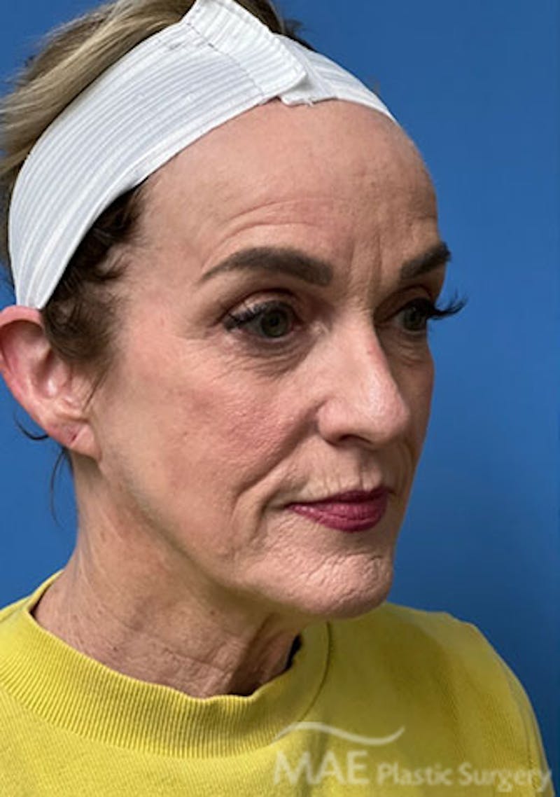 Facelift Before & After Gallery - Patient 394803 - Image 3