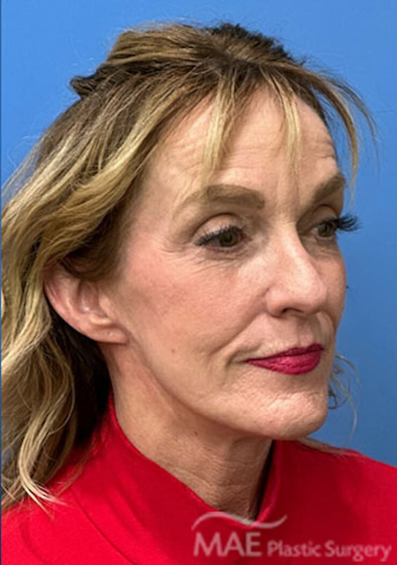 Facelift Before & After Gallery - Patient 394803 - Image 4