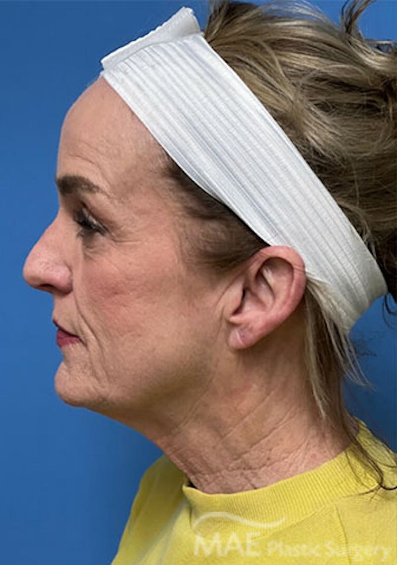 Facelift Before & After Gallery - Patient 394803 - Image 5