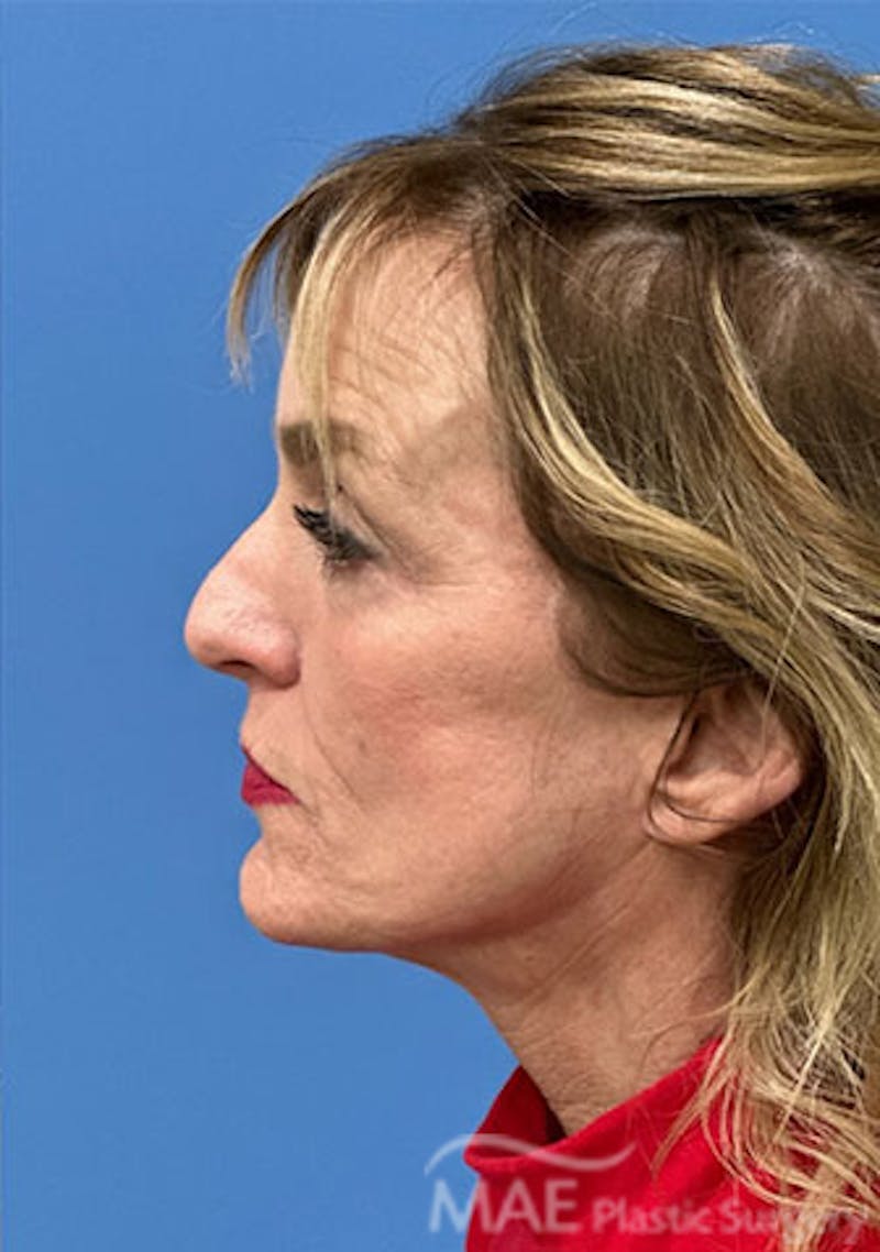 Facelift Before & After Gallery - Patient 394803 - Image 6
